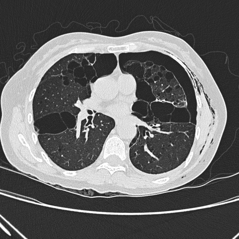 Non-contrast CT thorax 